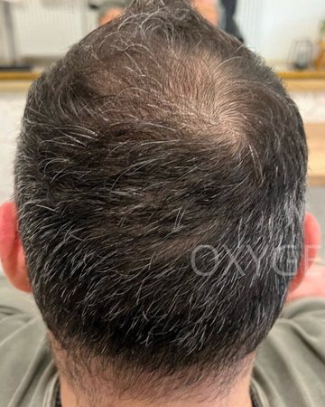 Prořídlé temeno před péčí