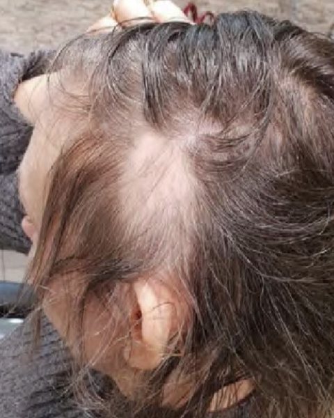 Ložiskové vypadávání na boku hlavy před péčí, ukázka z materiálů Oxygeni Hair