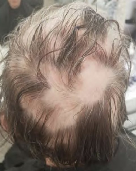 Ložiskové vypadávání na temeni před péčí, ukázka z materiálů Oxygeni Hair