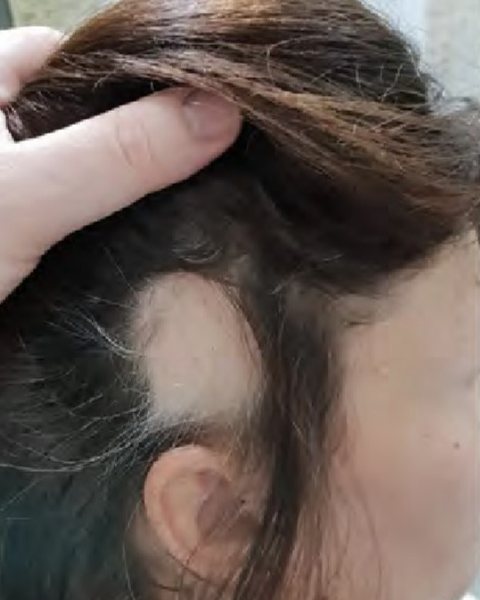 Ložiskové vypadávání nad uchem před péčí, ukázka z materiálů Oxygeni Hair