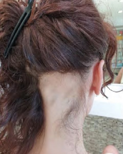 Ložiskové vypadávání v zátylku před péčí, ukázka z materiálů Oxygeni Hair